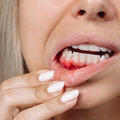 Bleeding Gums