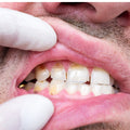 Cracked Corners of the Mouth