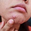 Cysts