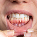 Gum Recession