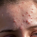 Inflammation