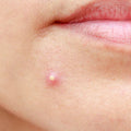 Pimples