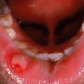 Redness Around the Ulcer
