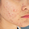 Redness and Irritation in the Mouth