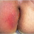 Swelling or Lump Near the Anus