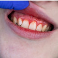 Gum Swelling