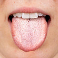 White Creamy Patches in the Mouth