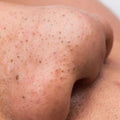 Blackheads