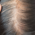 Thinning Hair