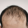 Receding Hairline