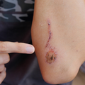 Slow-Healing Wounds