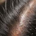 White Flakes on Hair and Shoulders