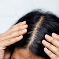 Dry Scalp