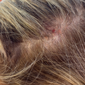 Scalp Redness
