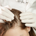 Hair Fall Associated with Scalp Irritation