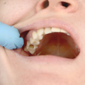 Visible Holes in Teeth