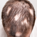 Bald Patches