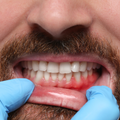 Swollen Gums