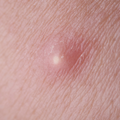 Pus or Fluid Discharge
