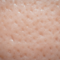 Small Flesh-Colored Bumps