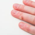 Clusters of Wart-Like Growths