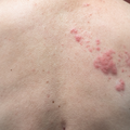 Moist or Raised Skin Lesions