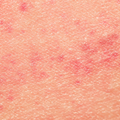 Irritation Around the Skin
