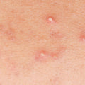 Whiteheads